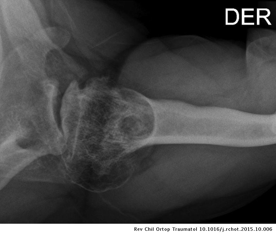 Osteonecrosis disbárica: la silenciosa enfermedad que corroe los huesos de los buzos salmoneros al sur de Chile